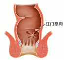 大腸息肉早期癥狀有哪些？